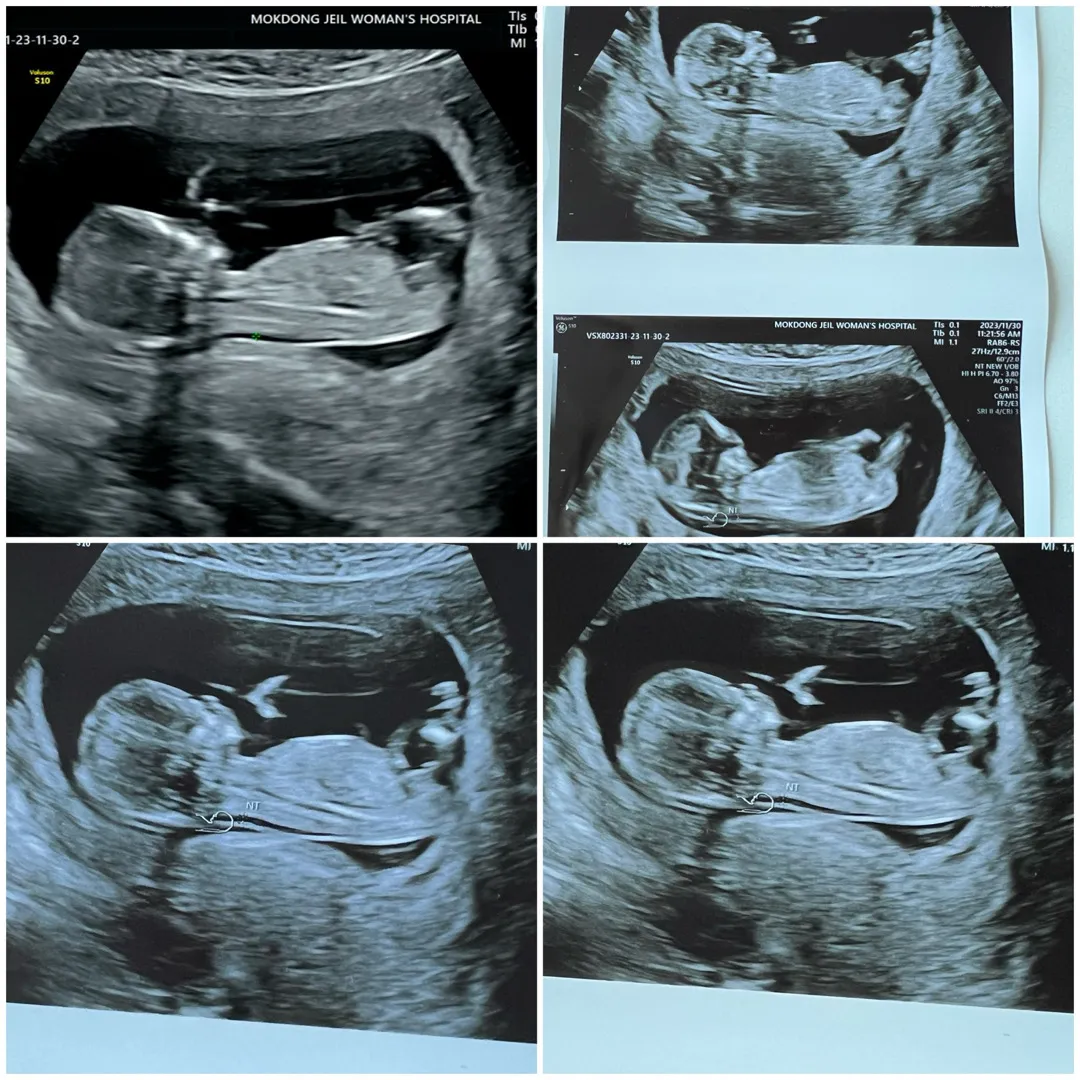 13주 2일 초음파 생식기가 보이나요??