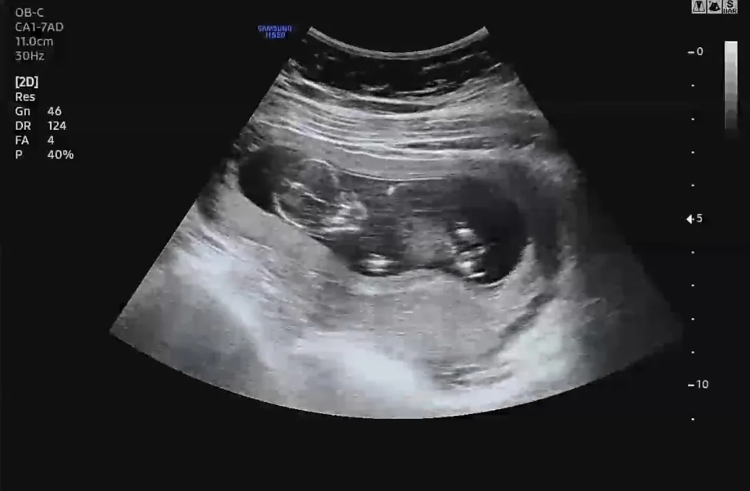 아기집이 좁아보여요ㅠㅠ
