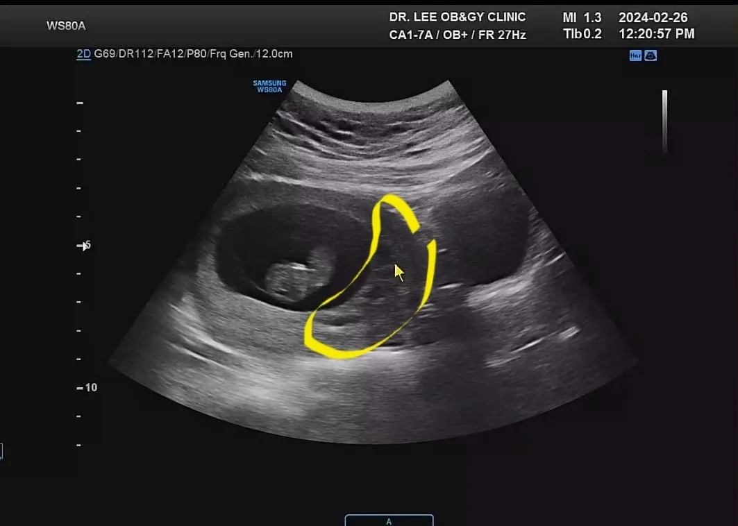 유산기 있다던데 심한편인가요?