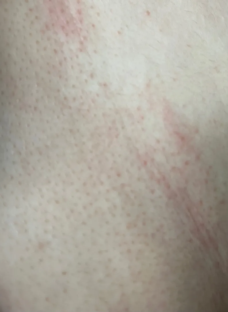 혹시 가슴이나 배 피부가 엄청 간지럽고 빨갛게 변한 분들 있나요?(사진있음)