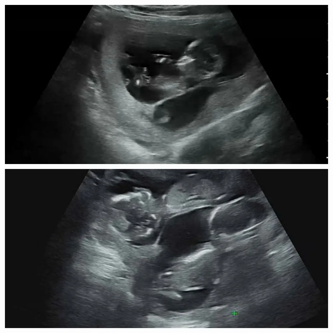 쌍둥이 각도법 한번 봐주세요!