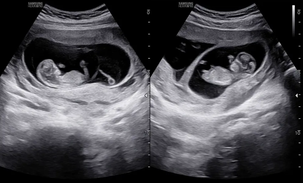 쌍둥이 11주 2일 각도법 궁금해요!!