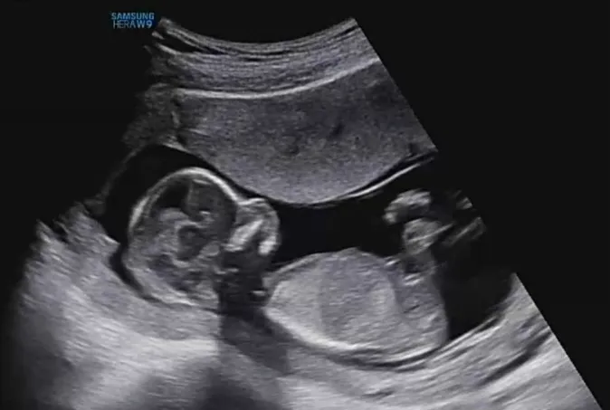 14주 2일차 초음파 옆모습으로 성별 알수있나용?
