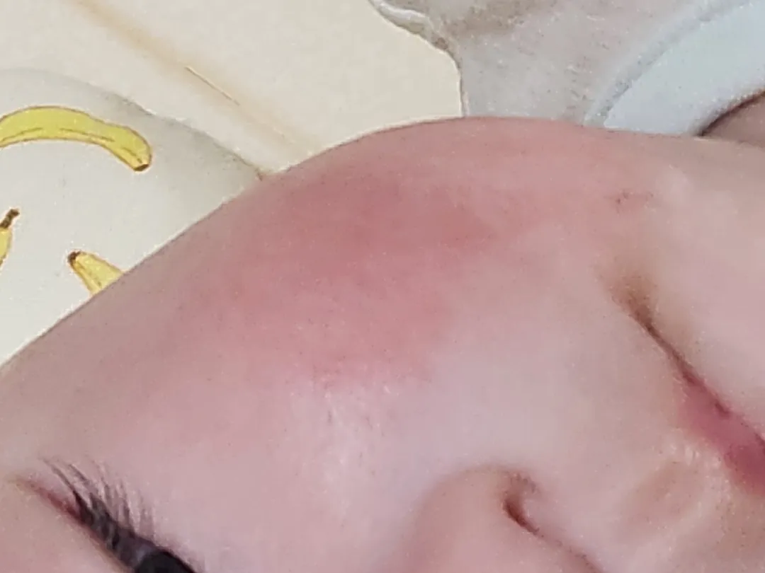 아기 볼이 빨개요