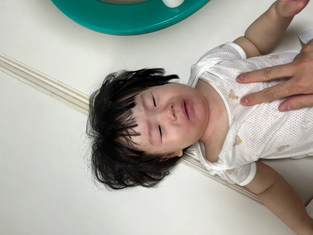 아이알러지병원가봐야할까요?