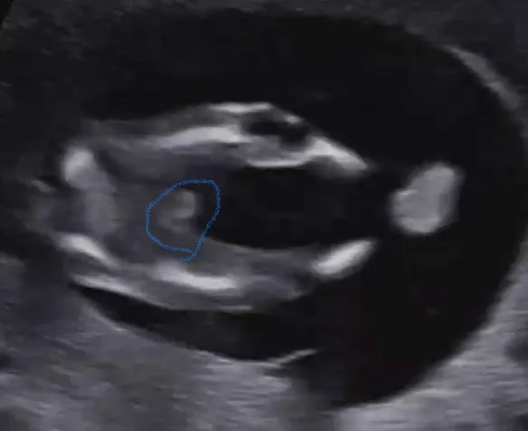12주 초음파 성별 판단이 가능할까요???