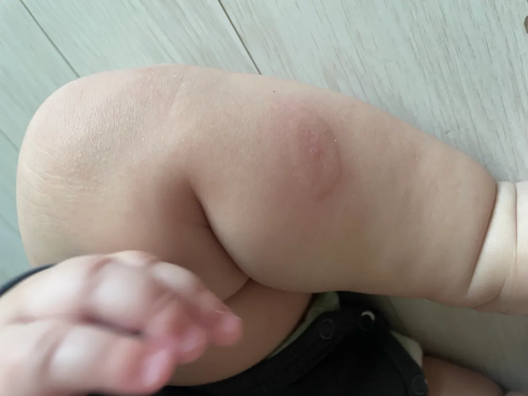 모기물린 거 맞겠죠 ?