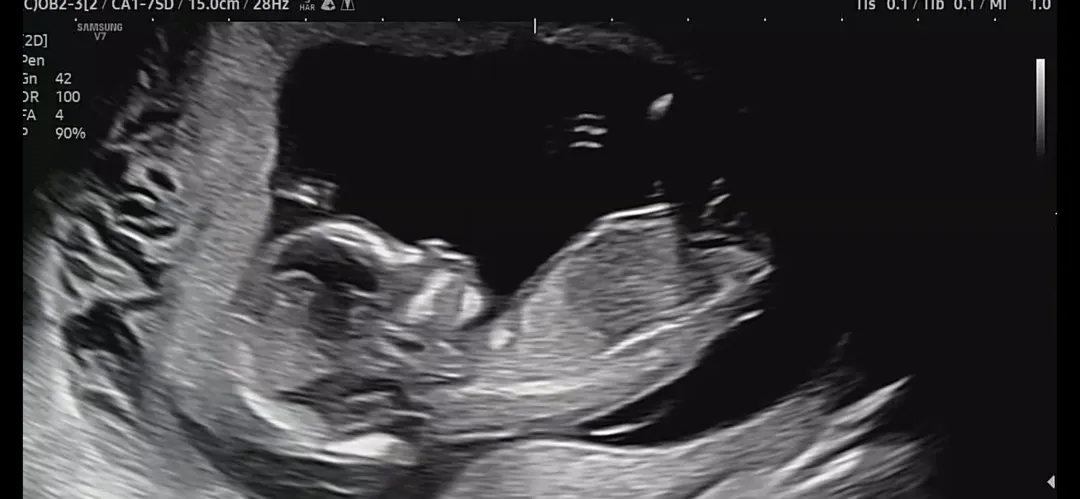 13w4d 성별은?!