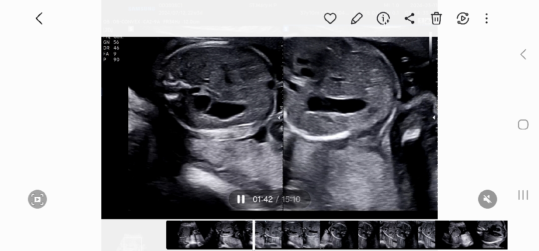 22주 정밀초음파 재검 이상ㅜㅜ