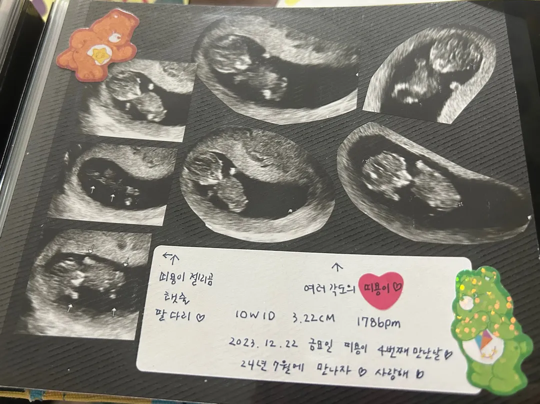 초음파 사진 꾸미기🫶