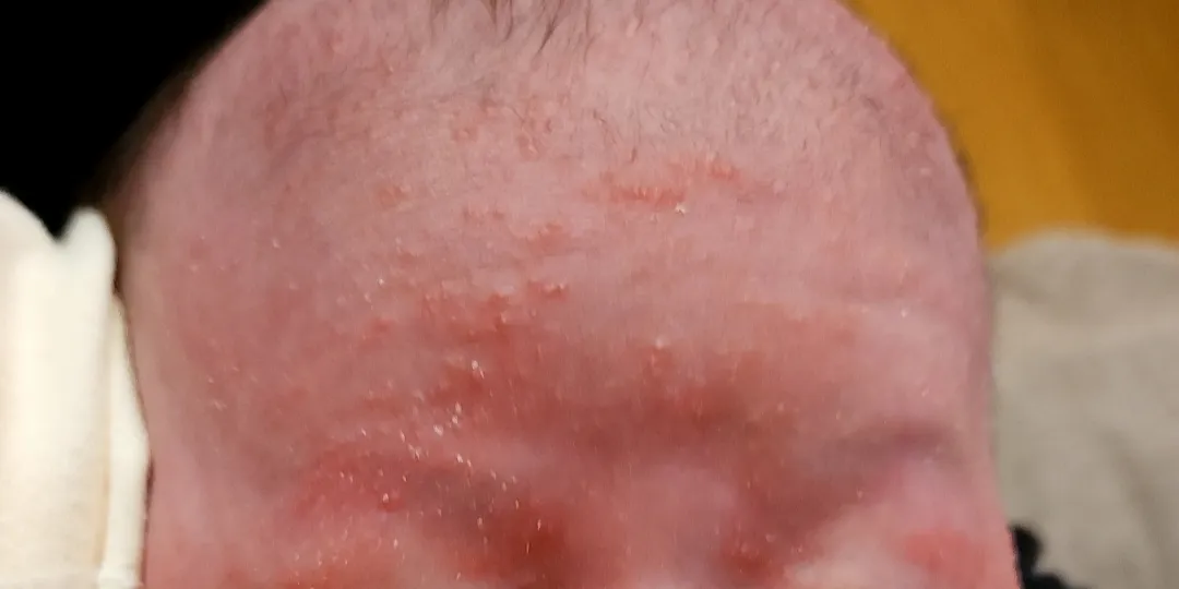 신생아 여드름ㅜㅠ하...