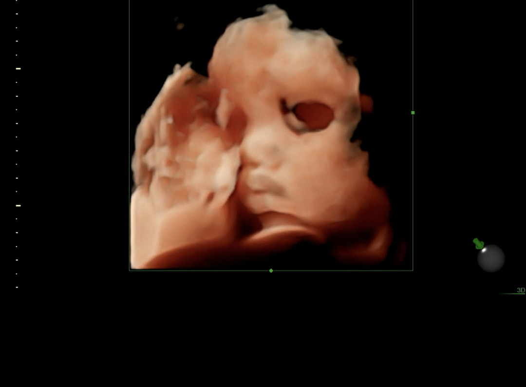 32주4일차 입체초음파!