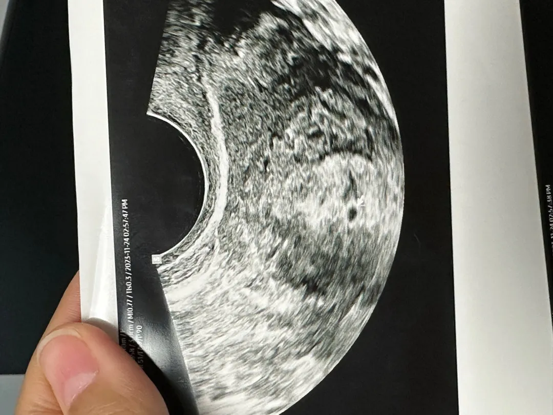 아기집 봤어요!!!! 너무 신나요!!!!