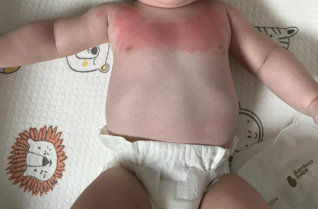 아기 가슴에 붉은 발진(?), 땀띠(?)..