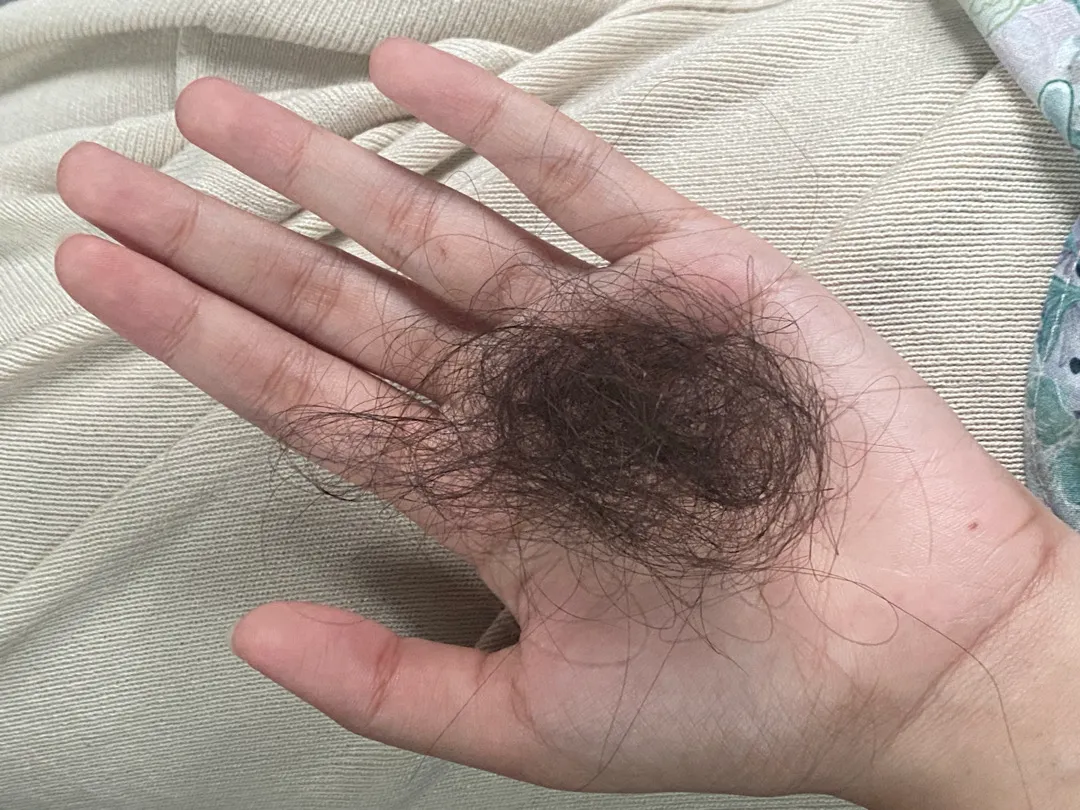 Rambut rontok