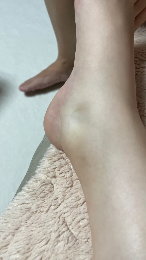 33주 산모 부종