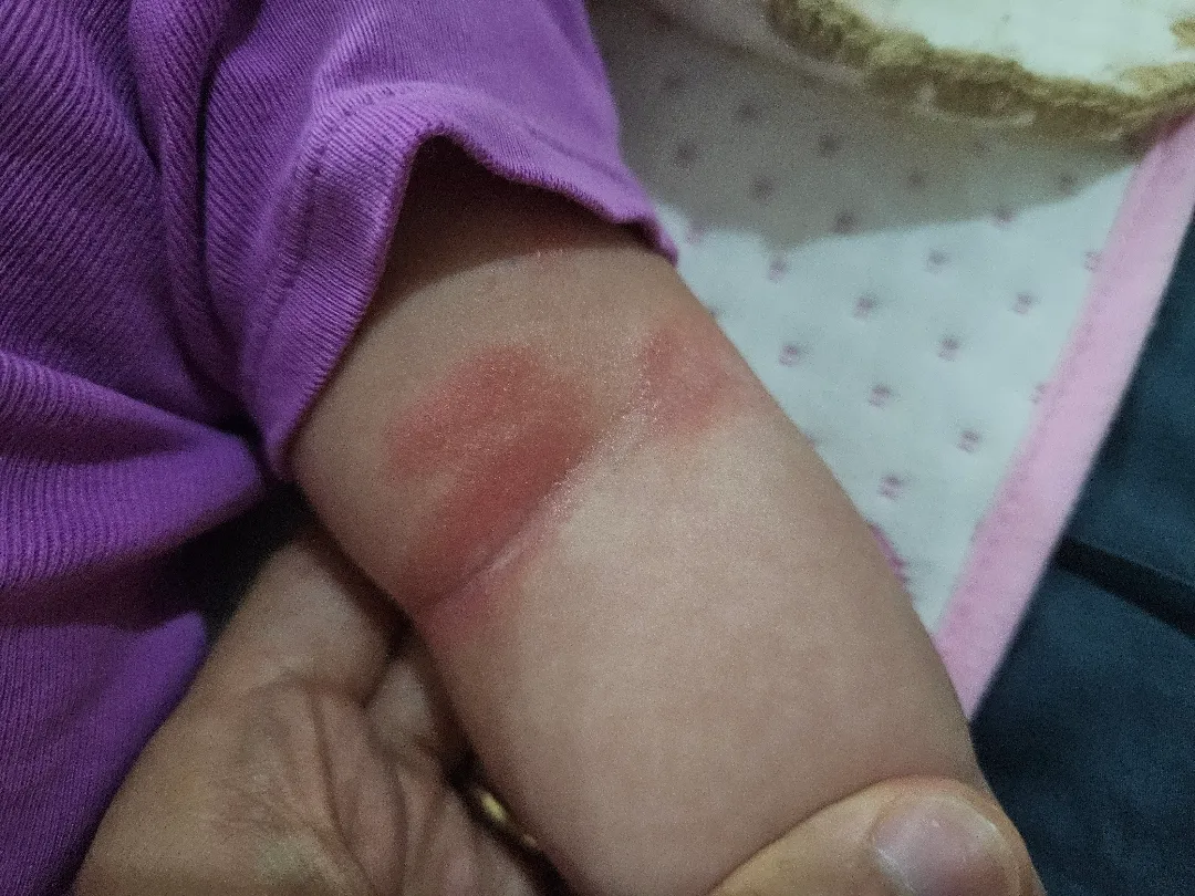 아토피? 태열? 봐주세요