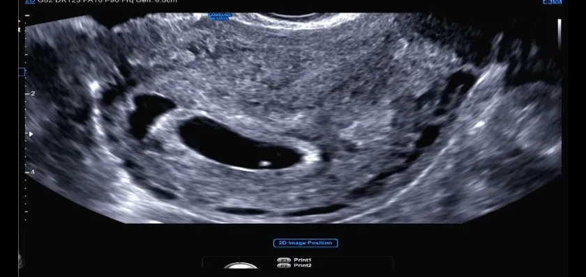7w5d 초음파 봐주세요
