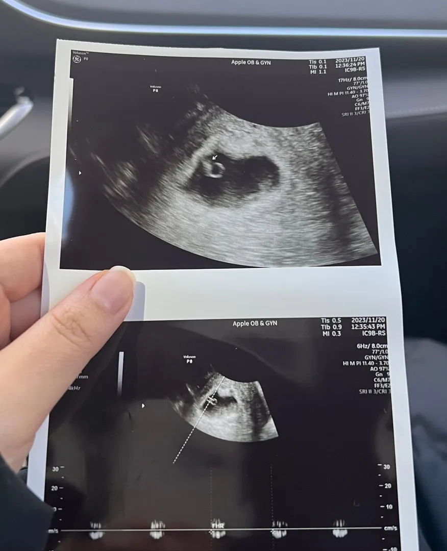 6주3일차 초음파 보고왔어요 !