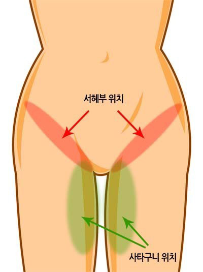 서혜부 통증 