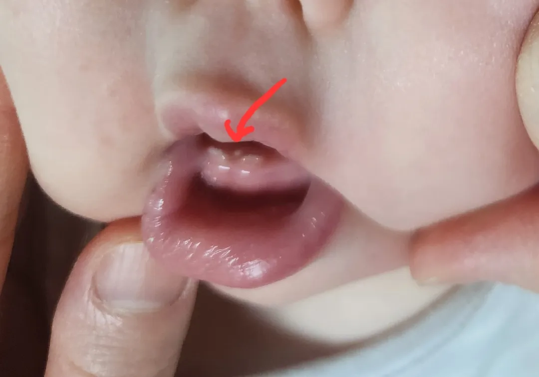 앞니 사이에 동그랗고 하얀게 있는데 이게 뭘까요?