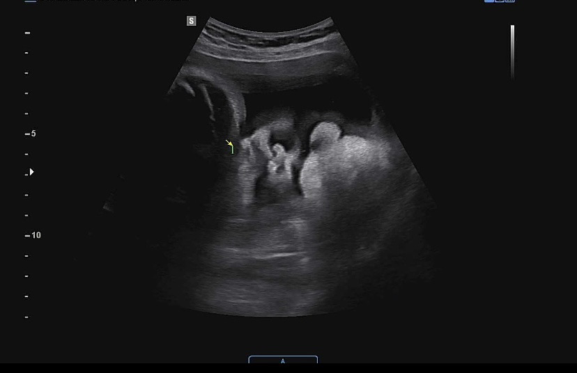 초음파 잘 보시는 분들 한 번 봐주세요~!!