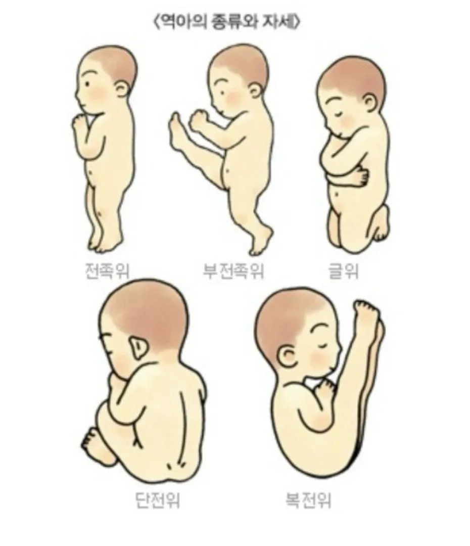 태아 자세 (복전위...?)