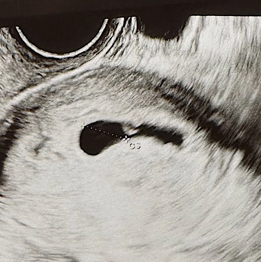 아기집이랑 난황보고왔어요☺️