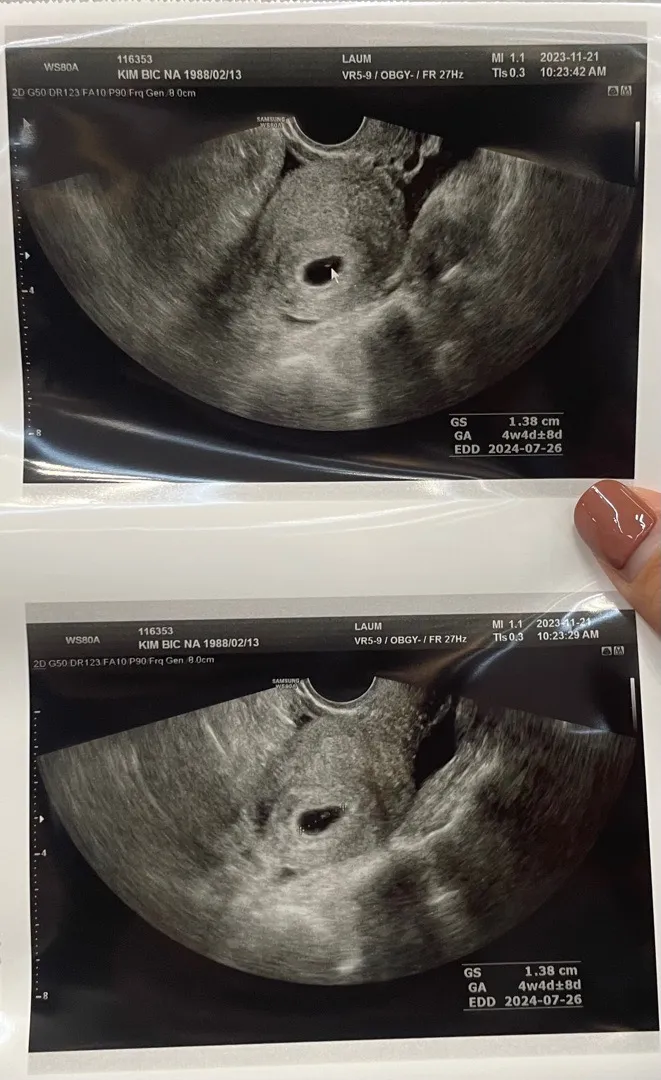 5주2일차 아기심장 내일가면 너무 빠른가요?! 