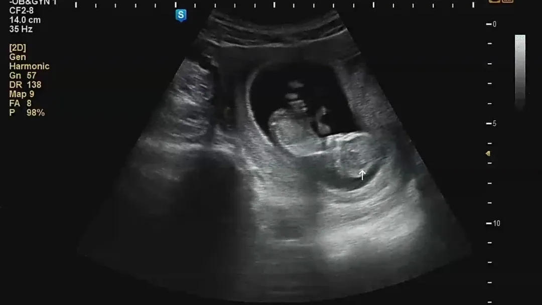 11주5일 성별을 먼저 말씀주시네요! 