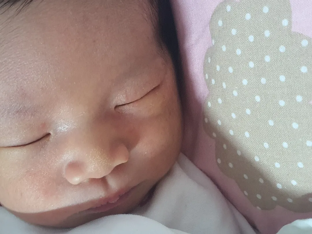 신생아 눈주위