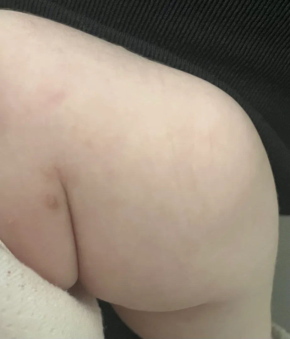 태열인줄알았는데 ㅜㅜ 피부이런분 계신가요??