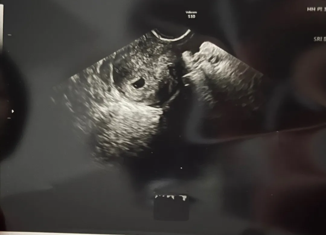 아기집 보고왔어요👶🏻