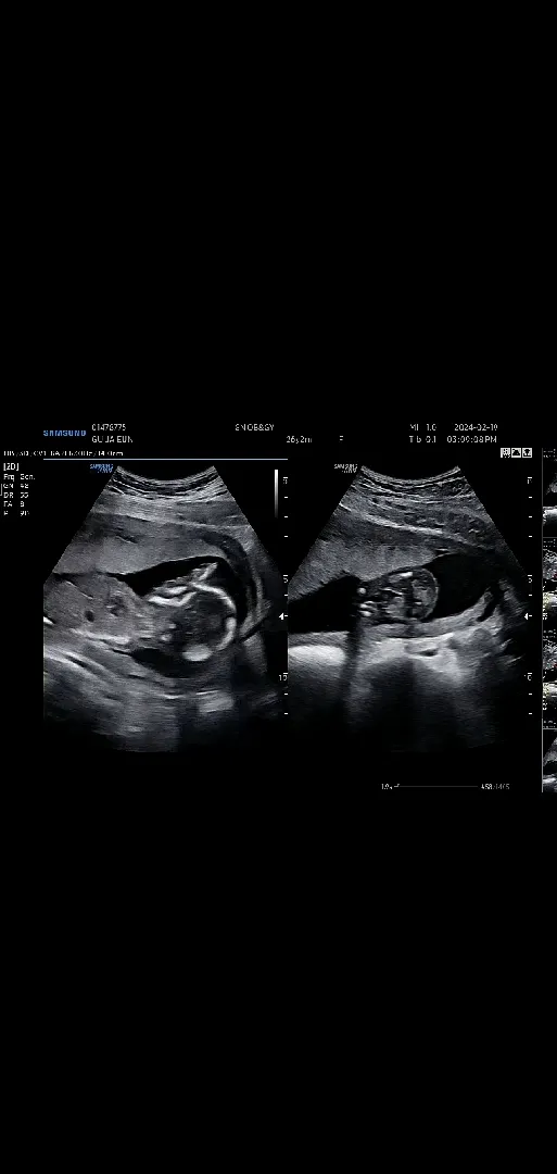 16주2일 병원다녀왔어요