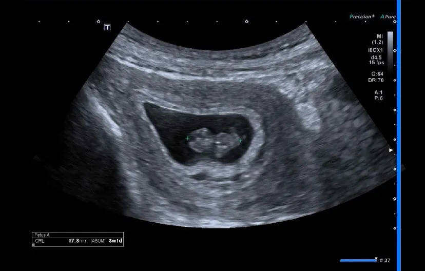 쿠아앙 오늘 아가 초음파 처음 보고 왔어요👶🏻💕