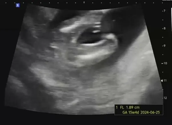 15주 초음파로도 성별확실할까요?