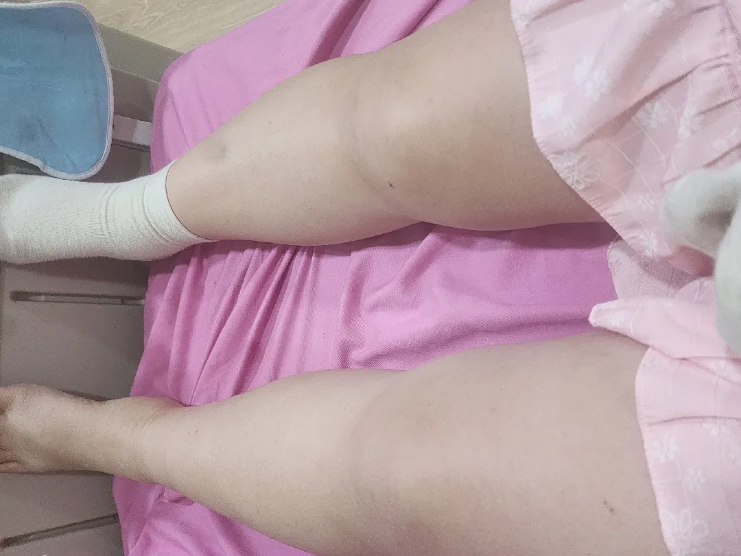 붓기 이게 맞나요ㅡ???? 발사진주의