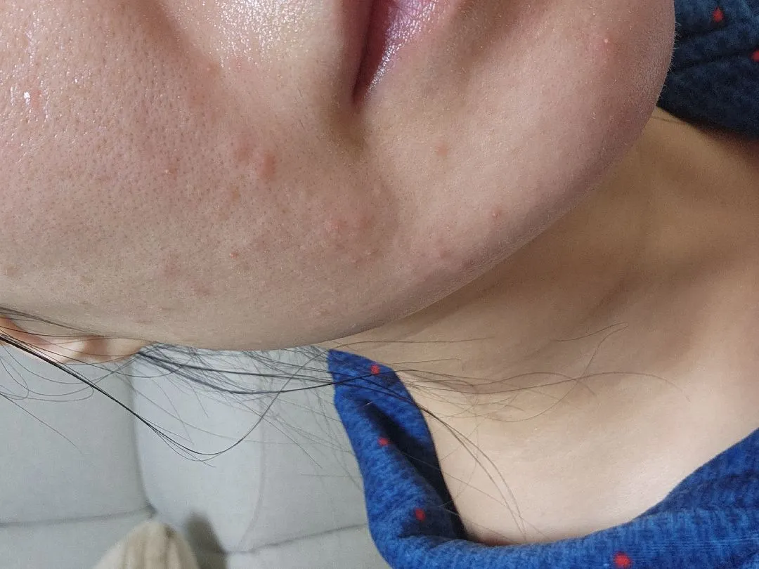 먹덧에 입덧에 이젠피부까지 다뒤집어지네요※여드름사진혐오조심※