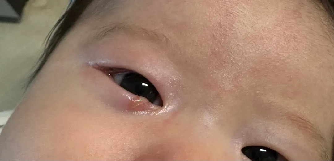 손톱상처 고름 병원 가야할까요?