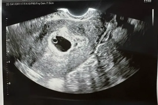 5주5일 다이아반지 확인과 심소듣고왔어요 ! 👶🏻