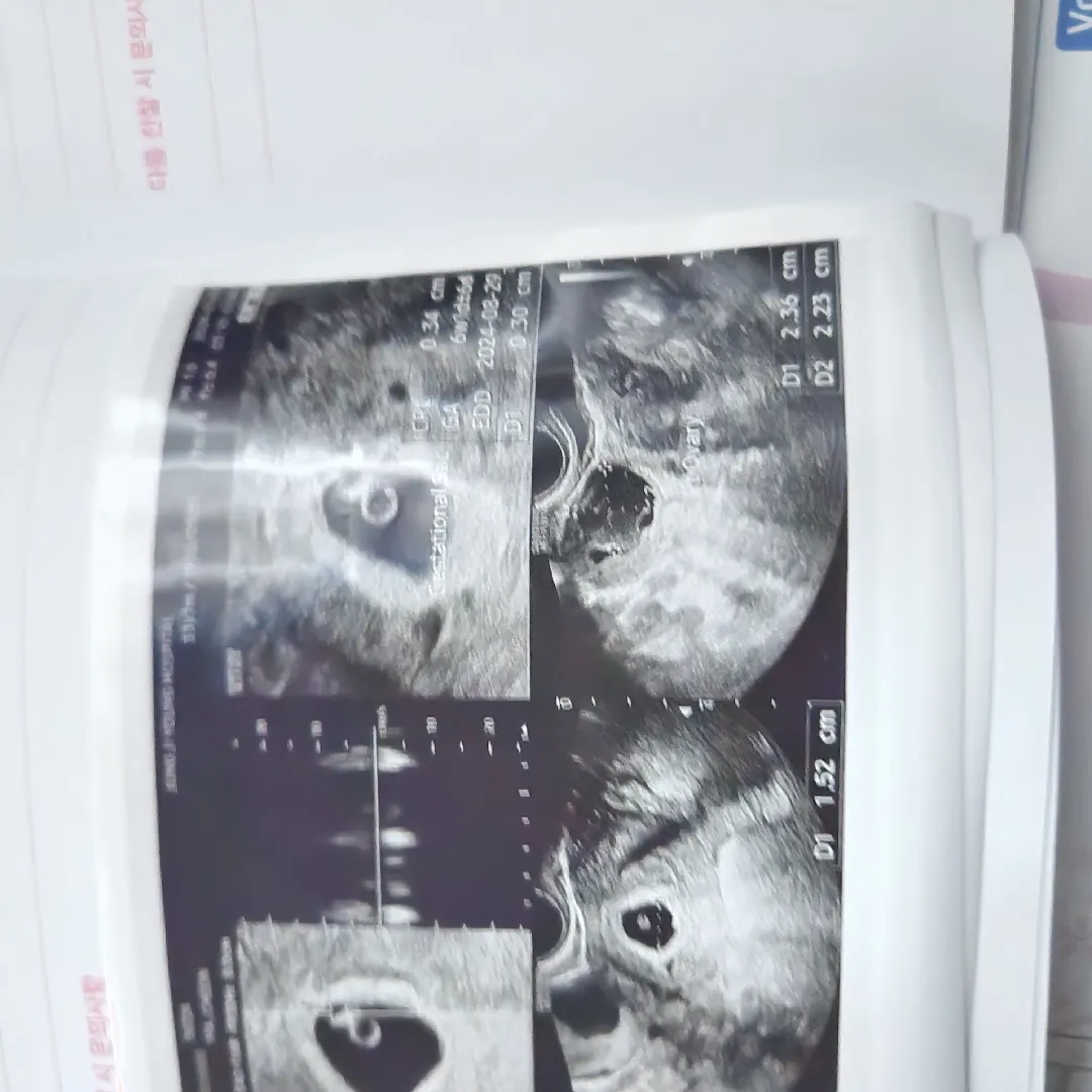 오늘 아기집도보고 난황도보고 초음파소리도들었어용