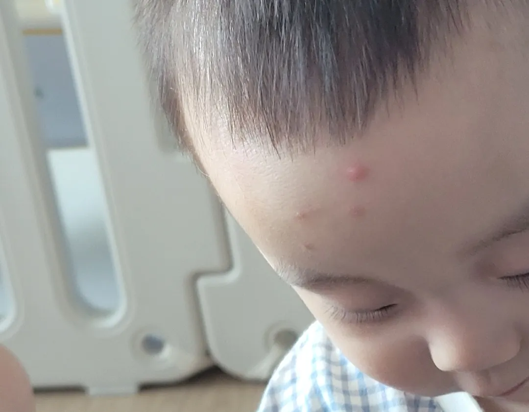 이마에 난거 뭘까요