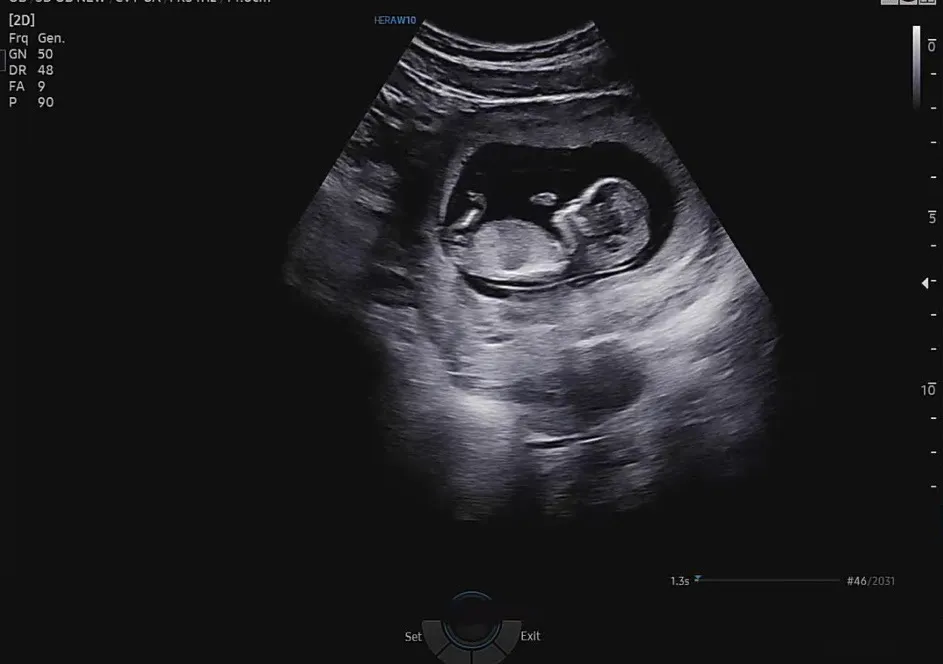 12주4일 초음파 성별 한번 봐주세요 :-)