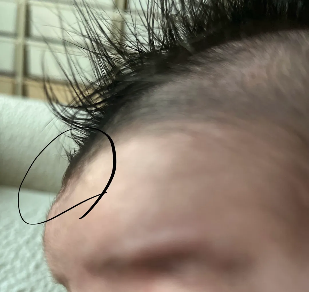 아기 이마가 움푹 들어가있어요 ㅠㅠ