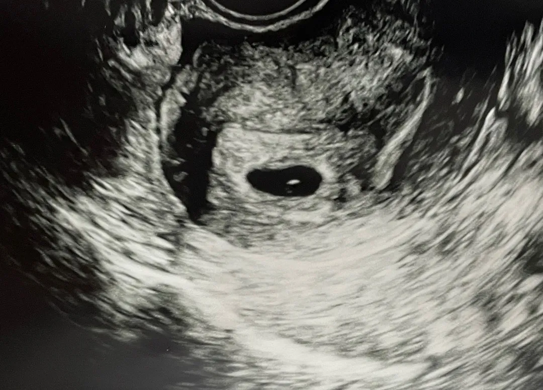 5주2일차 아기집 + 임산부뱃지