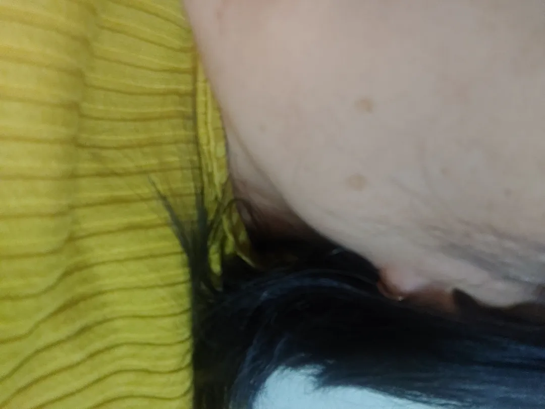 32주 얼굴 색소침착인지 기미인지..