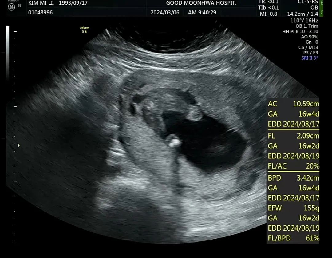 16w4d❤2차 기형아 검사결과