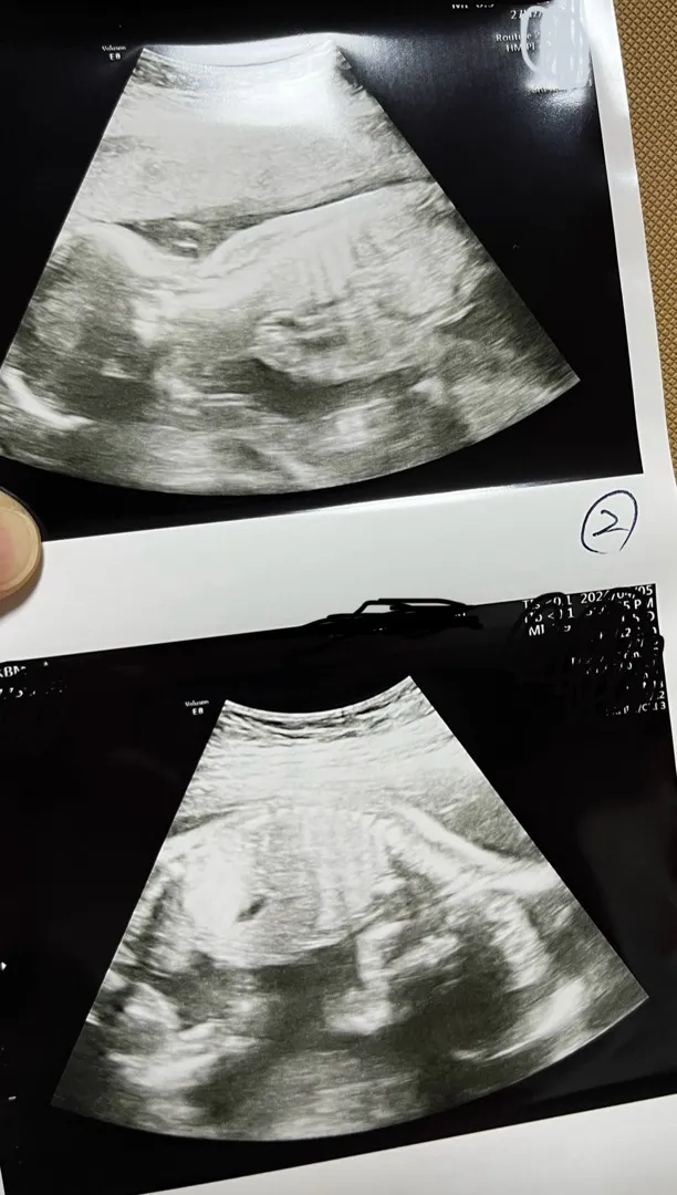 어제 정밀초음파 보고 왔어요 ㅎㅎ
