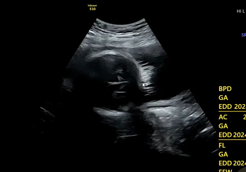 오늘 정기검진 다녀왔는데 머리숱 너무 귀여운거 있져 