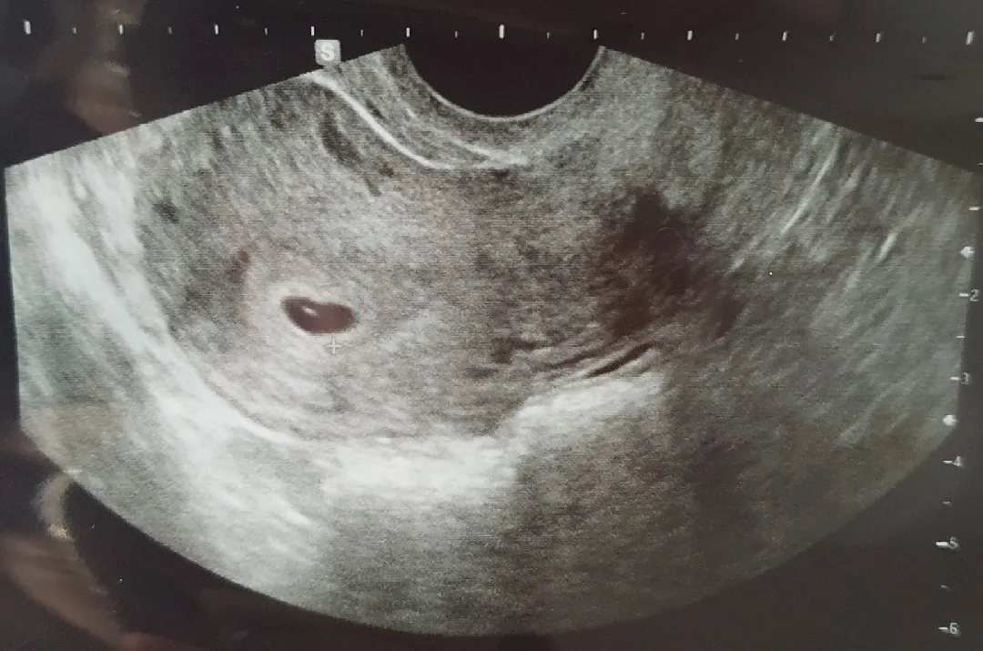 입사 3주차, 임신 5주차...!